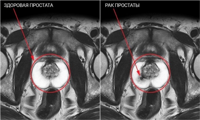 Prostate cancer photo